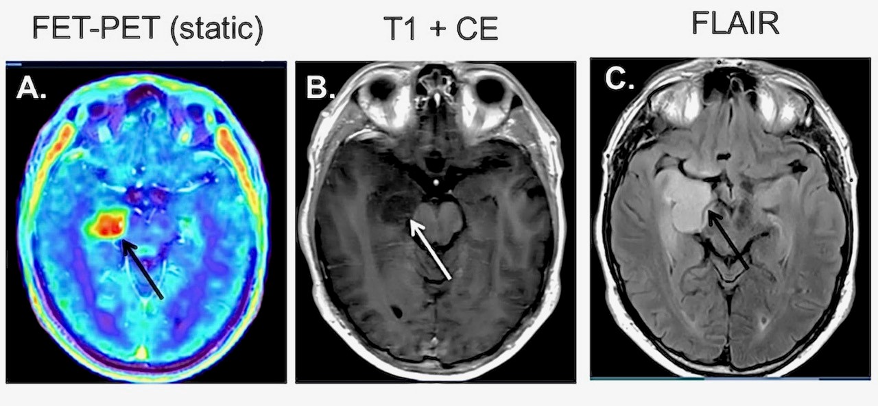 FET-PET-scan voorbeeld